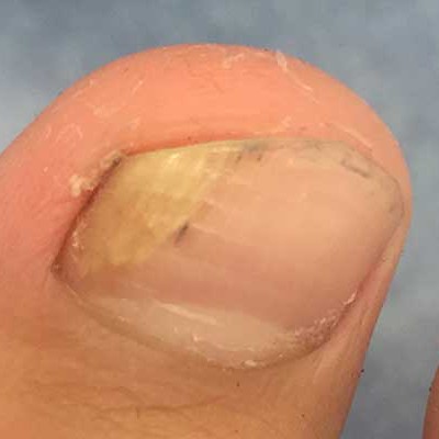 TRATAMENTO PARA FUNGOS UNGUEAL-1° Tratamento p/ 1°sessão,- Em sua maioria, são ocasionadas por fungos alojados na região. Após a avaliação realizada é recomendado o tratamento com laser. 1° sessão com a loção p/ tratamento.