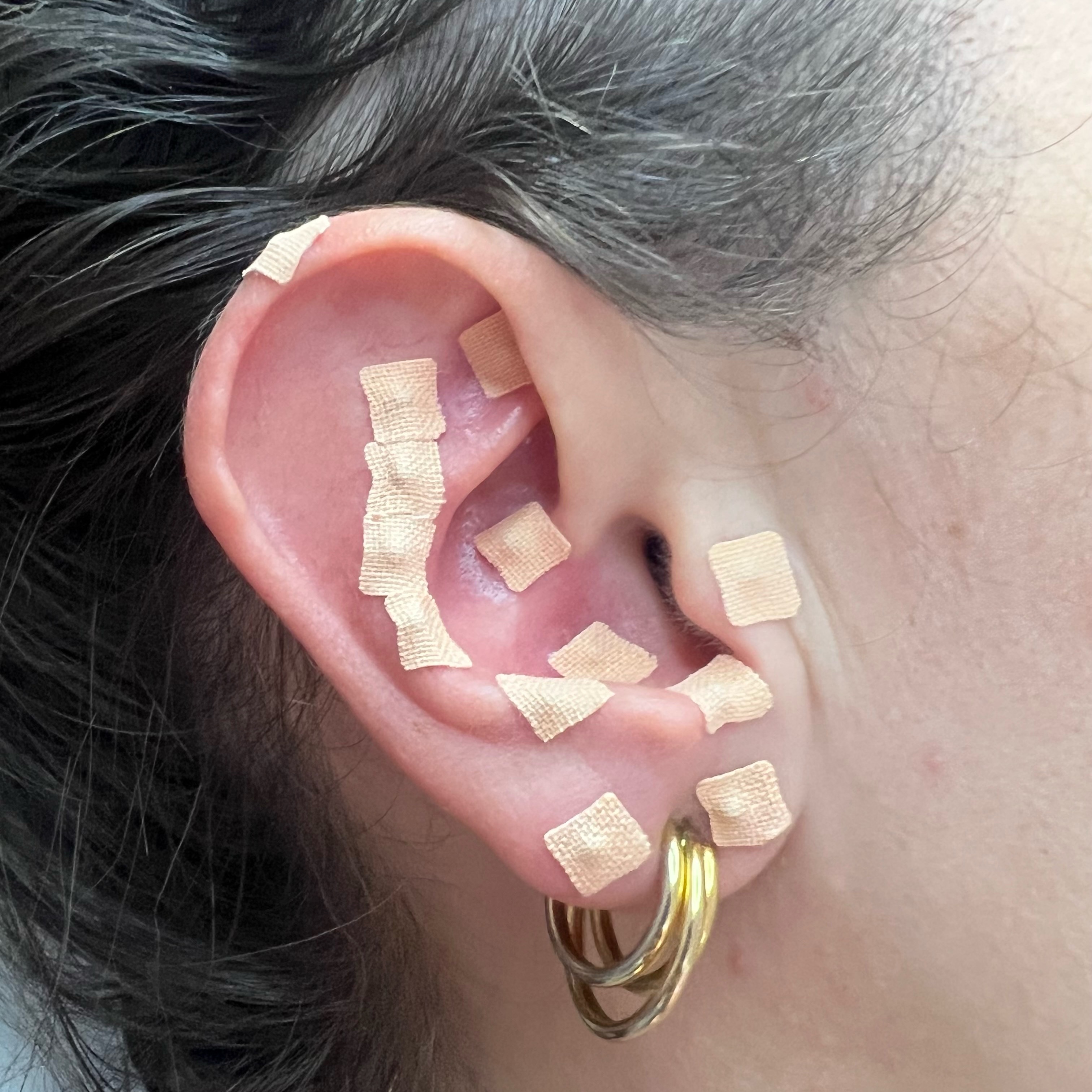 Auriculoterapia