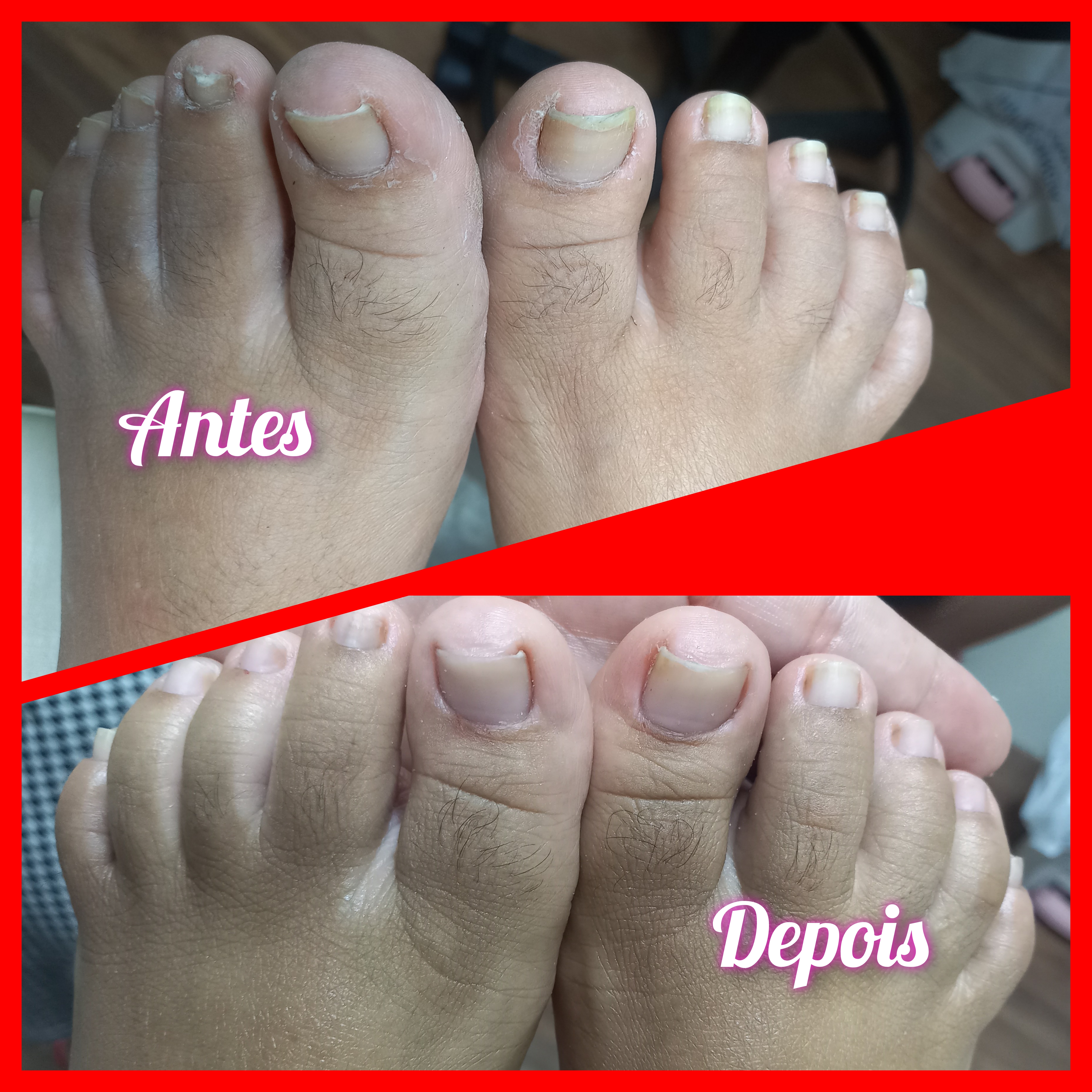 Podoprofilaxia (limpeza geral dos pés)