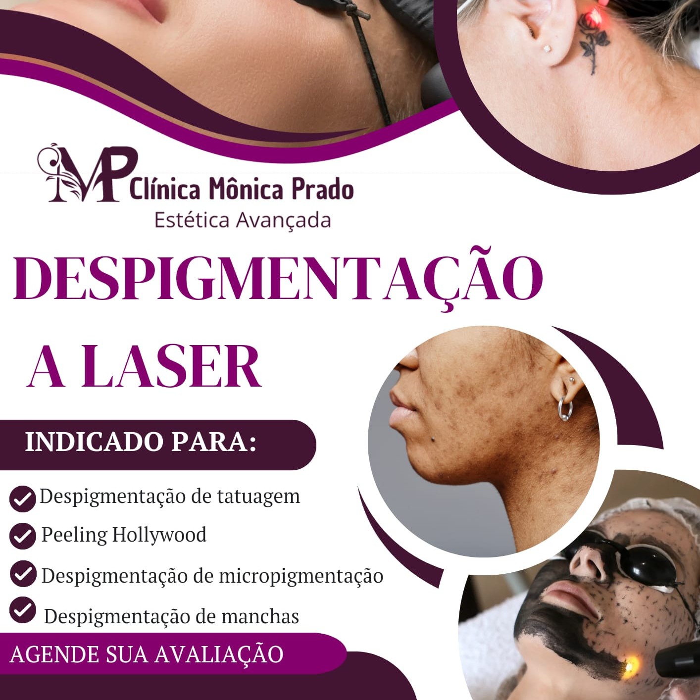 Remoção de micropigmentação de sobrancelhas