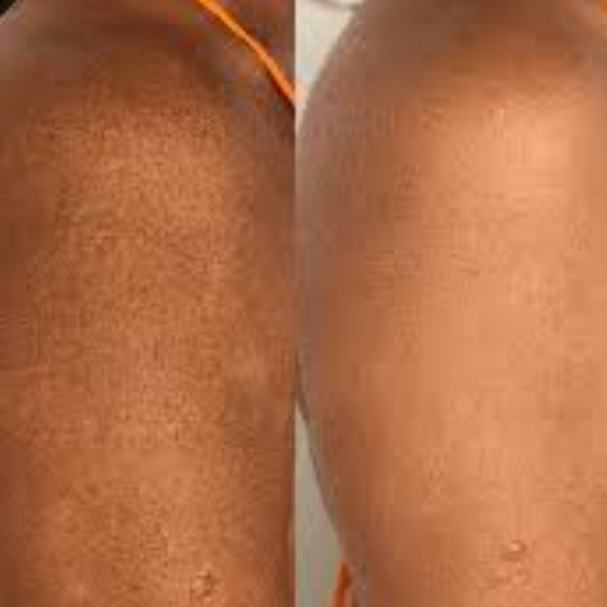 Peeling Corporal