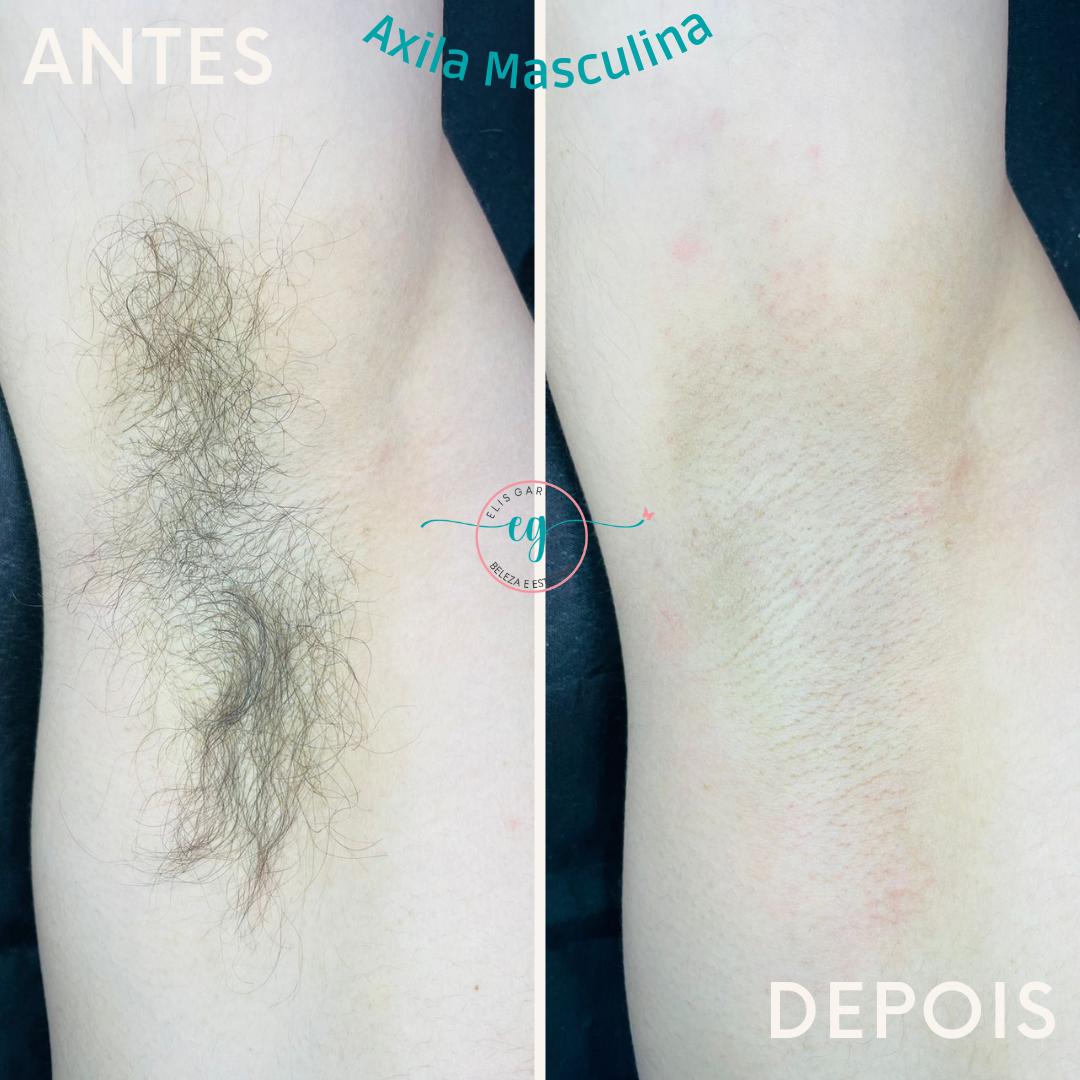 D'Epilação Axilas masculino