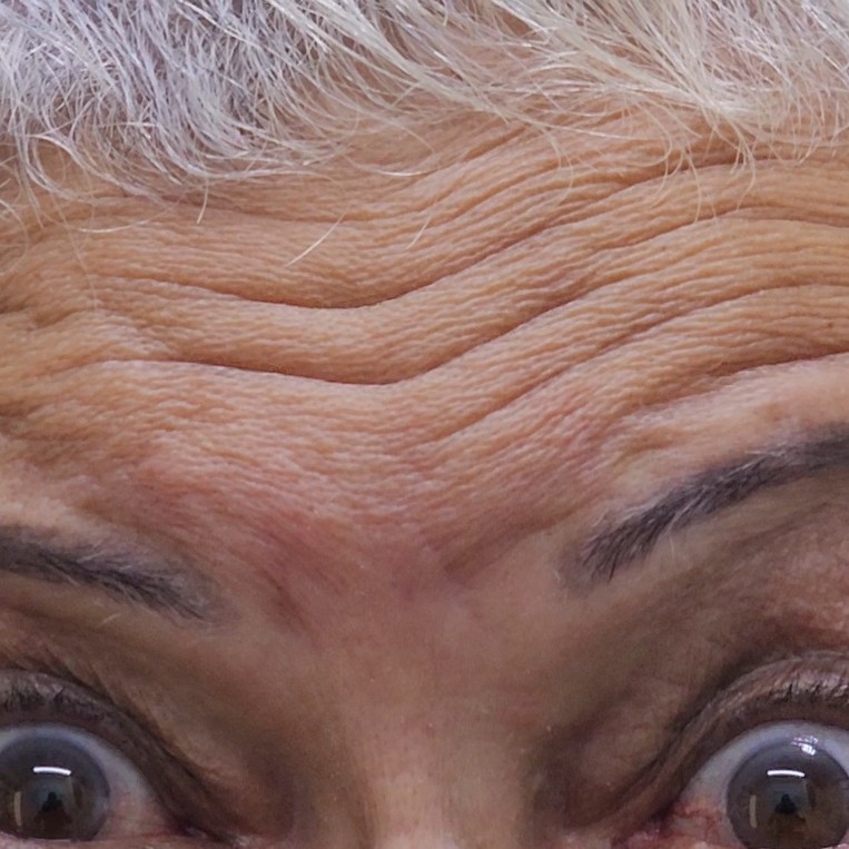 BOTOX - 50ui (sem retoque)