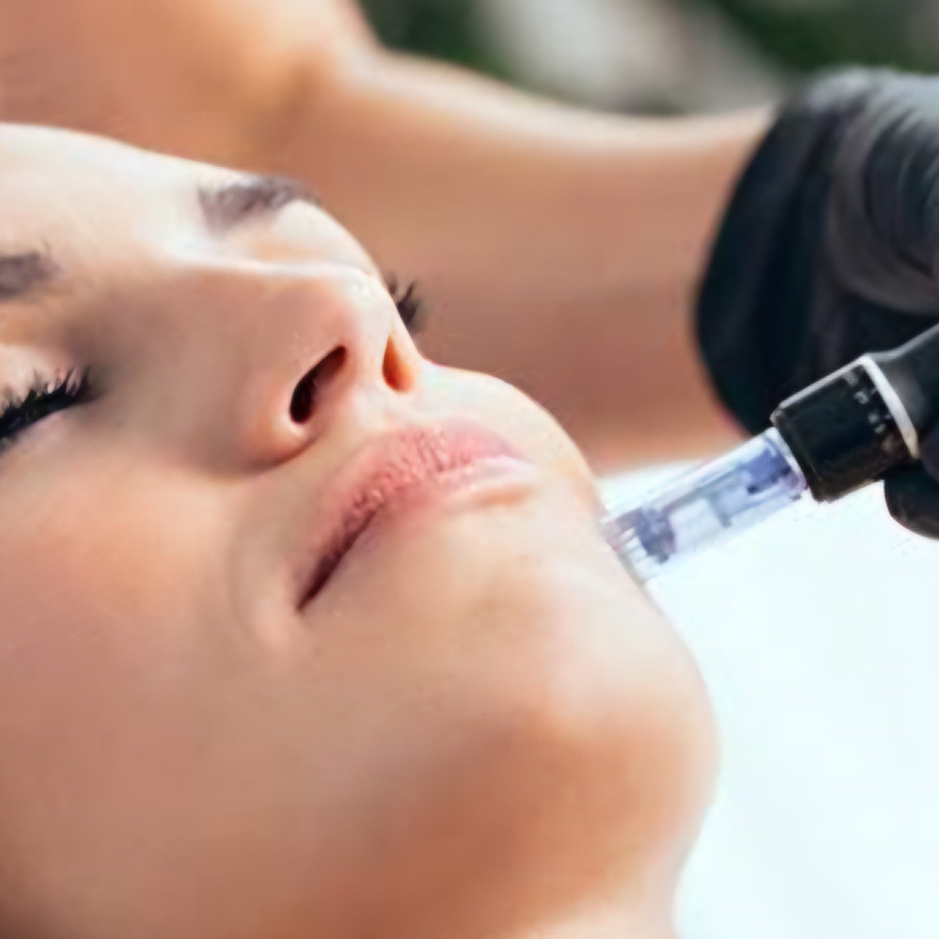 microagulhamento facial