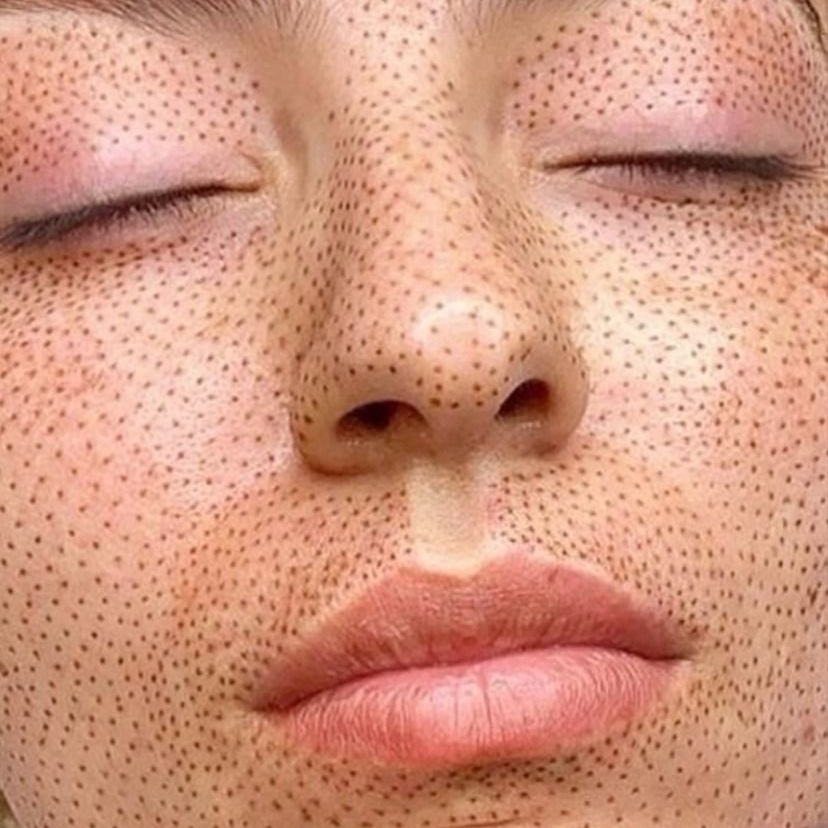•JATO DE PLASMA• remove sinais , linhas de expressões, verrugas, rugas, tatuagem, etc.