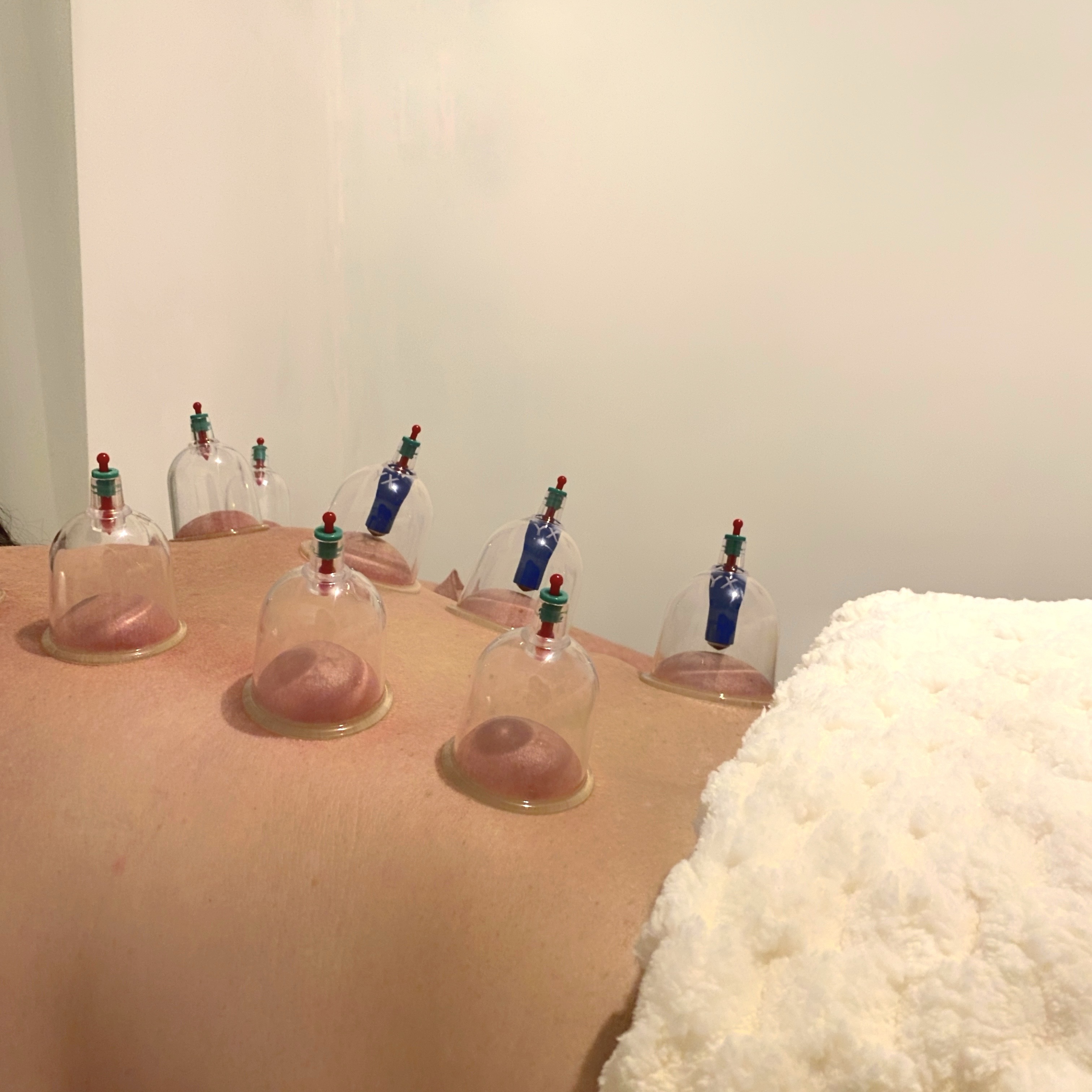 Ventosoterapia e massagem relaxante