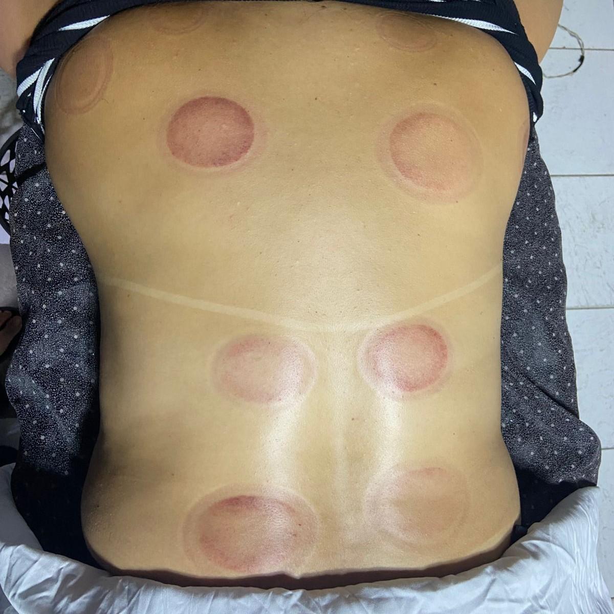 Ventosaterapia com massagem