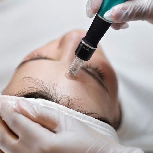 Microagulhamento Facial