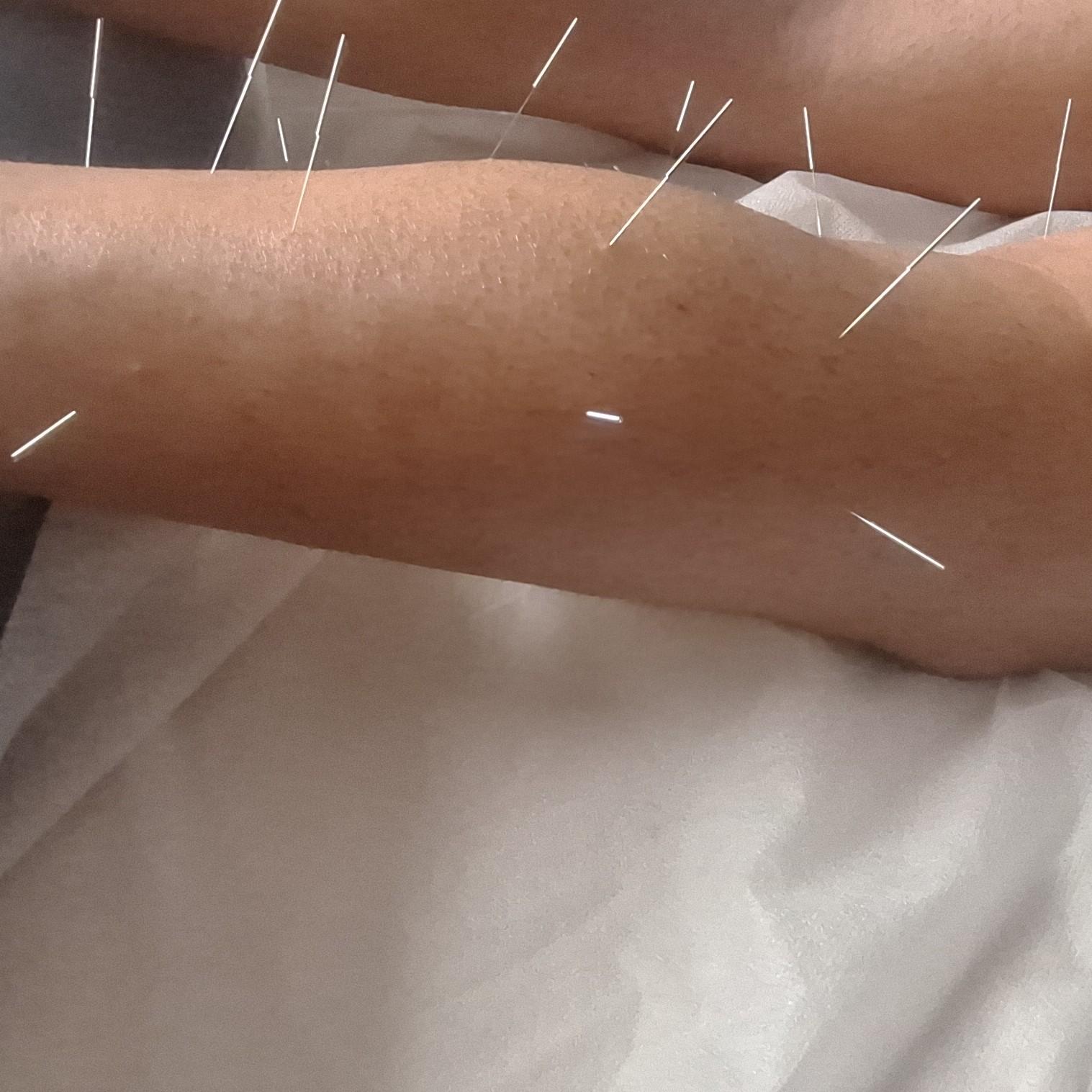 Acupuntura