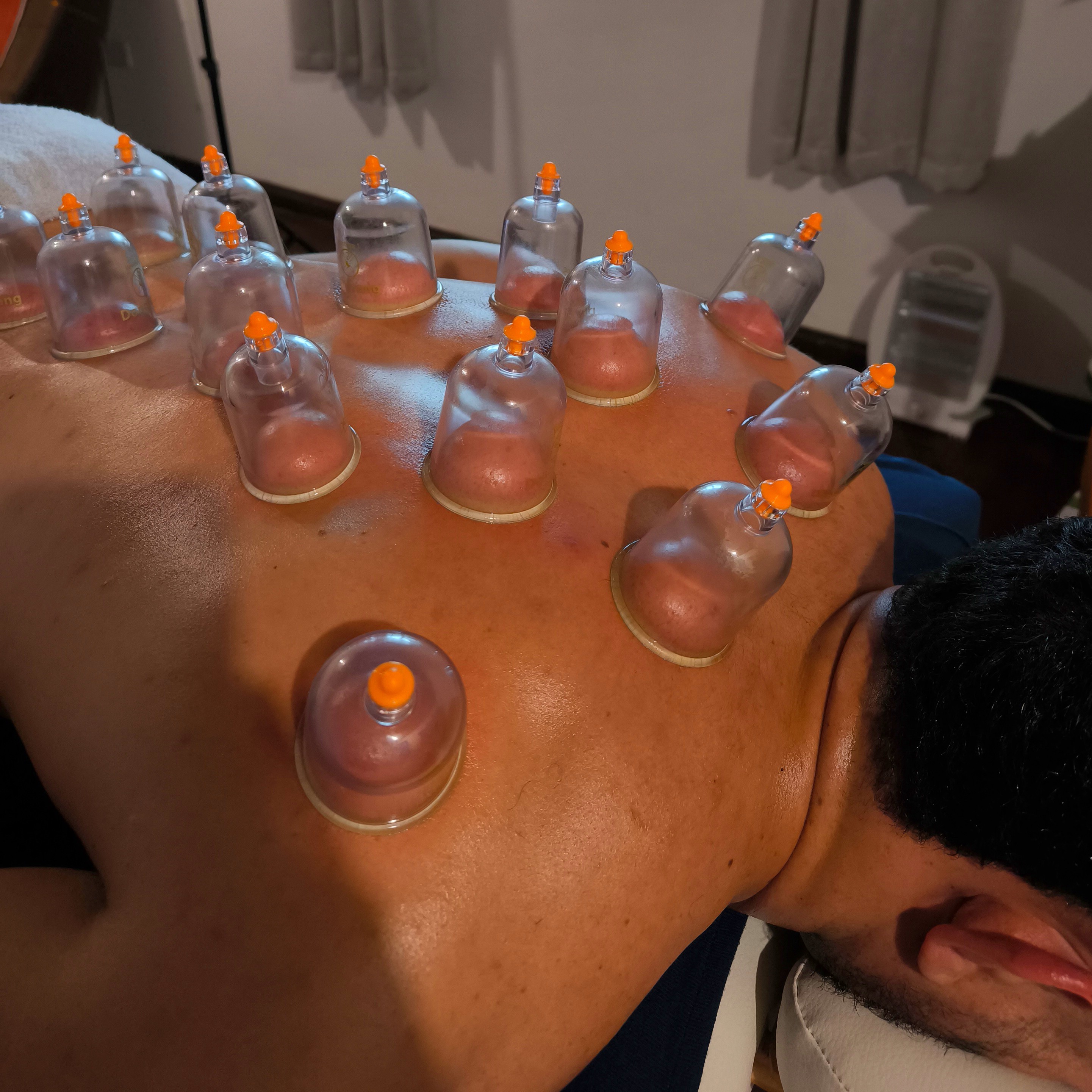 Ventosaterapia (com fogo, de acrílico ou silicone)
