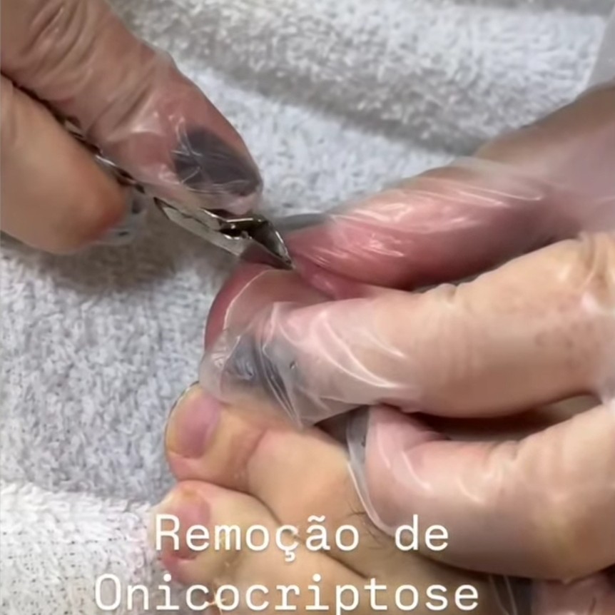 Remoção de Onicocriptose