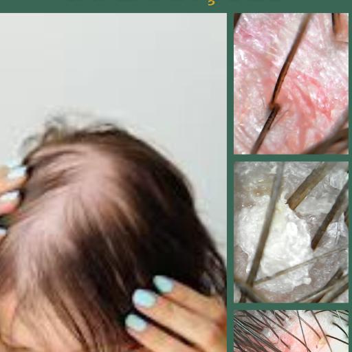 Fototerapia para tratar de disfunção do couro cabeludo