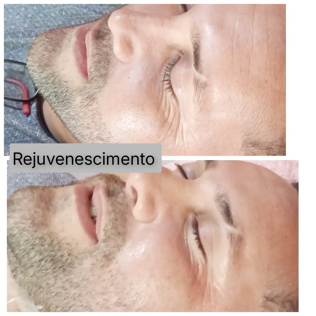 Mescla Para Rejuvenescimento da Área dos Olhos!