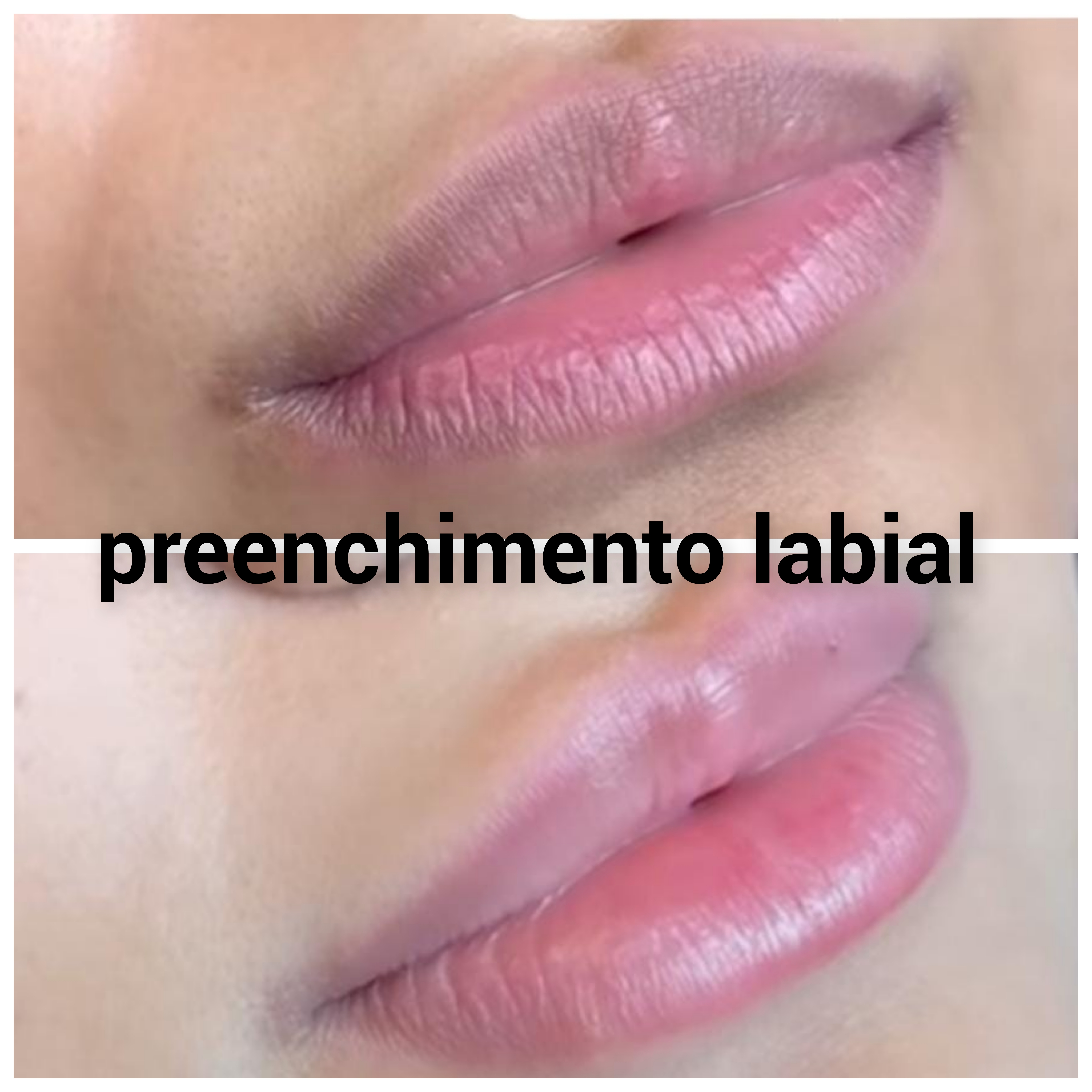 preenchimento labial ( valor por de 1ml)