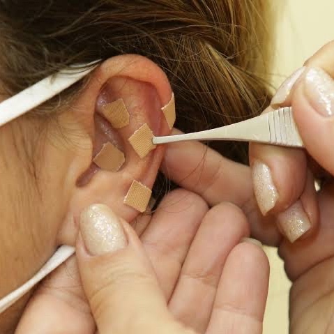 1 SESSÃO DE AURICULOTERAPIA