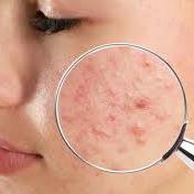 Tratamento para acne