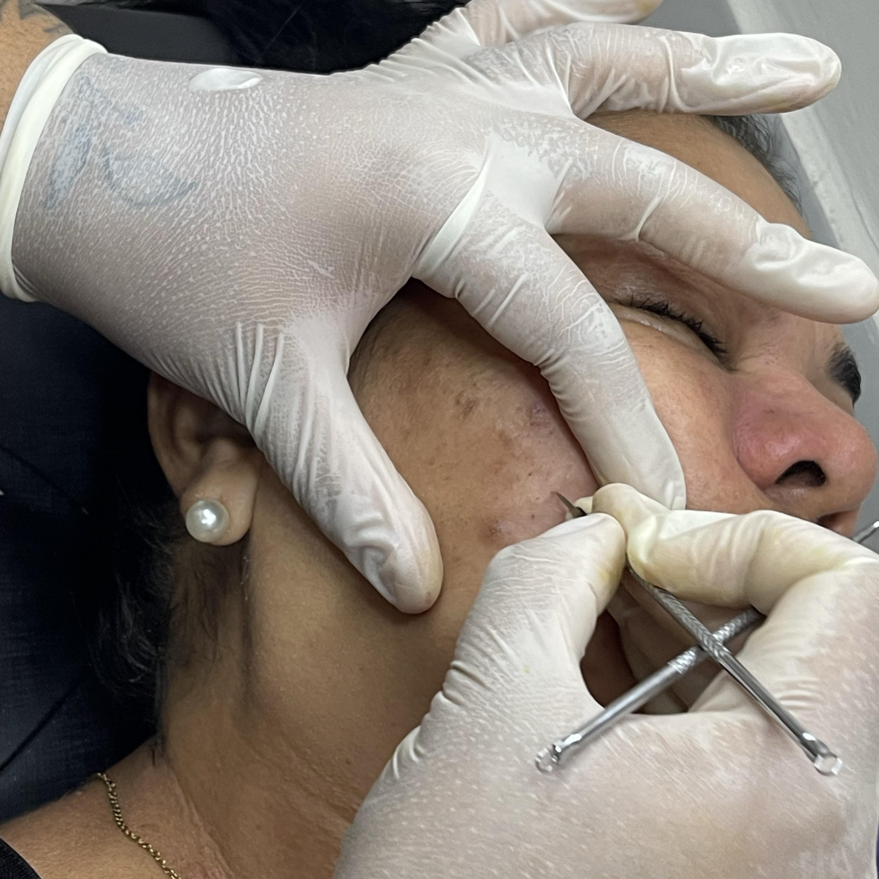Limpeza Facial com Extração de Cravos