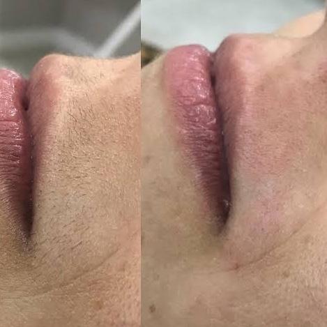 Depilação Buço Linha ou Cera