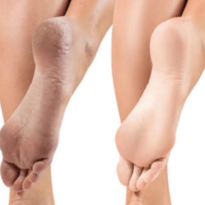 PLÁSTICA DOS PÉS (Remoção de calosidade) com cutilagem e esmaltação