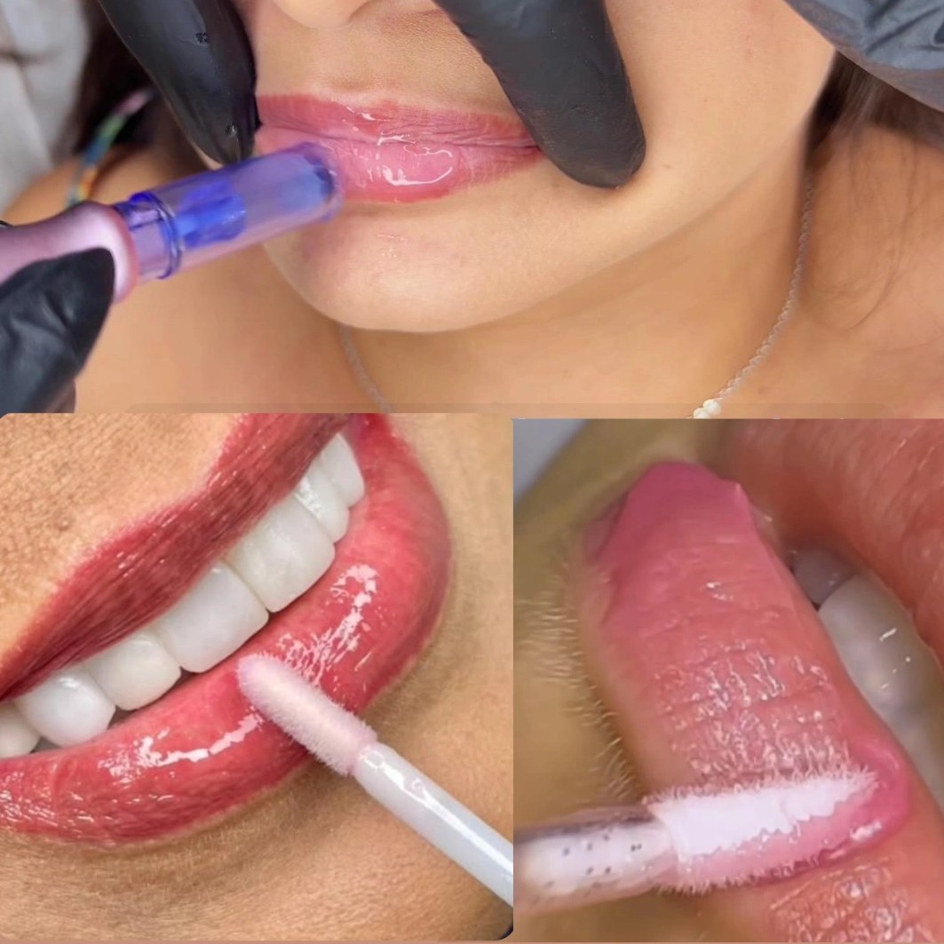 MICROAGULHAMENTO LABIAL