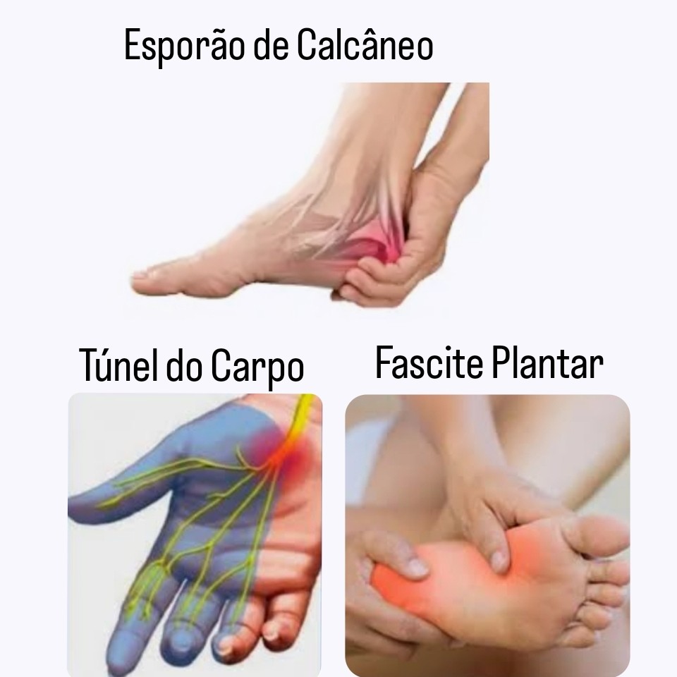 REFLEXOLOGIA PODAL E PALMAR : trata fascite plantar, esporão de calcâneo e túnel do carpo