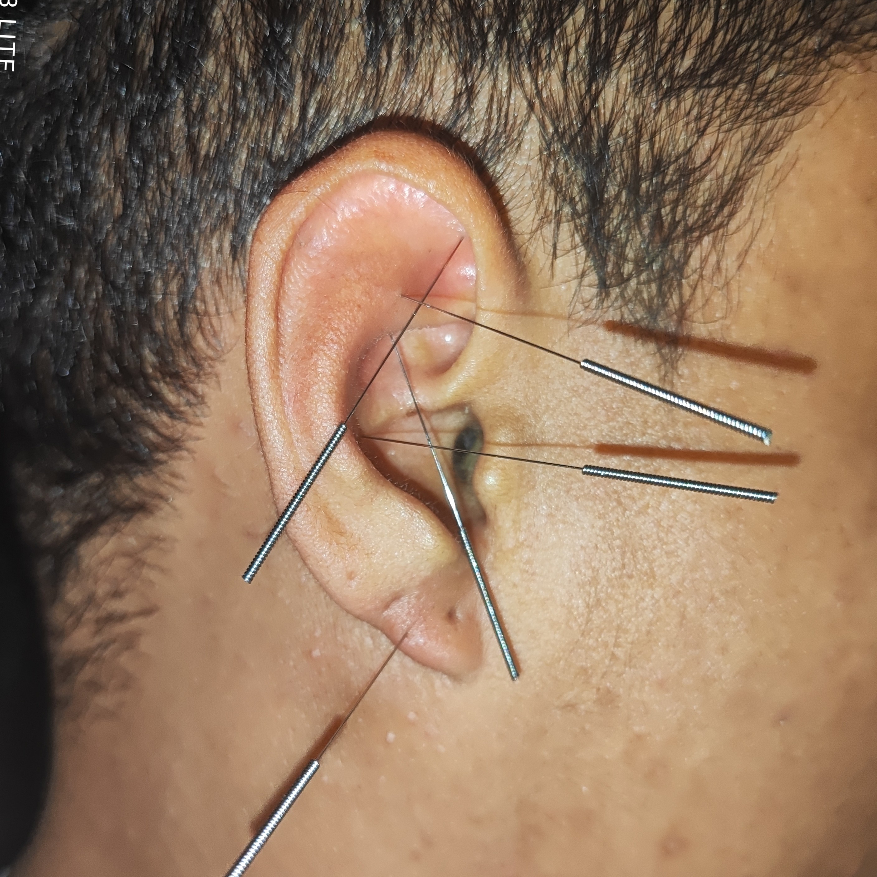 AURICULOTERAPIA