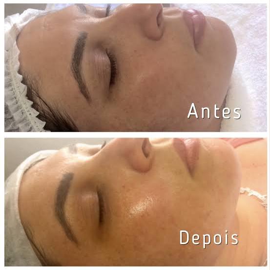 Revitalização Facial com Fios de Seda