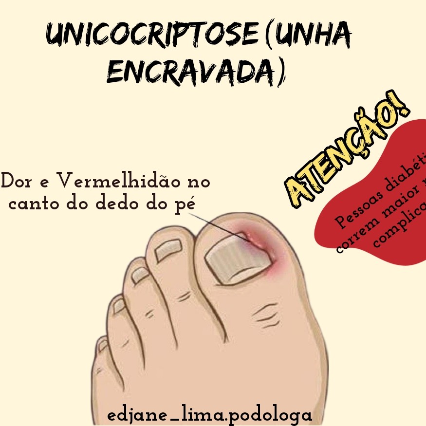 ONICOCRIPTOSE ( unha encravada )/ 1 Hálux (polegar)