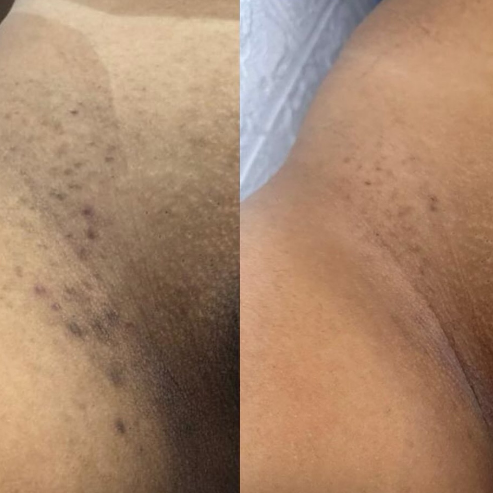 Pacote Clareamento íntimo 1 área axila ou Virilha 6 SESSÕES