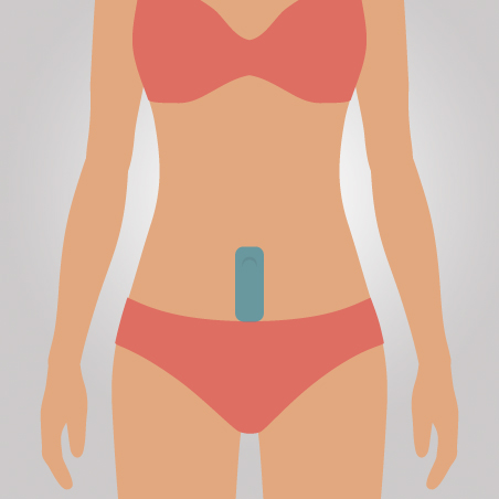 linha infra umbilical