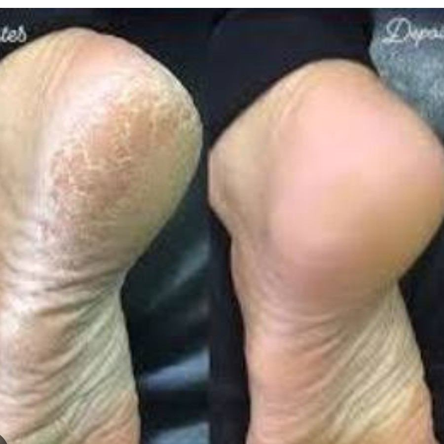 Plástica dos Pés (remove calos e rachaduras superficiais)