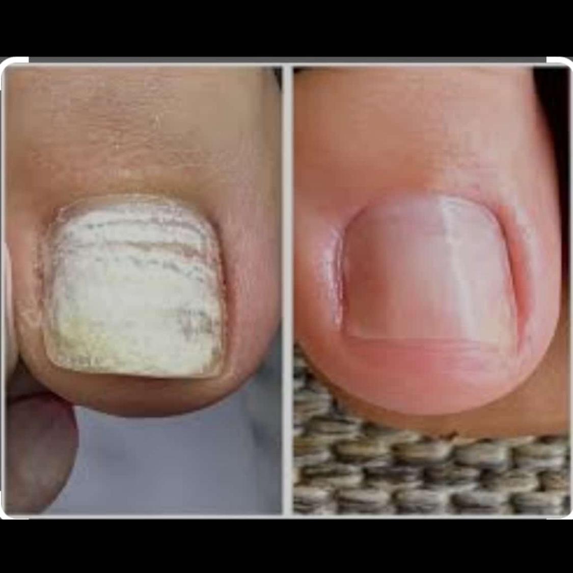 Detox nas unhas. retirada leuconíquias