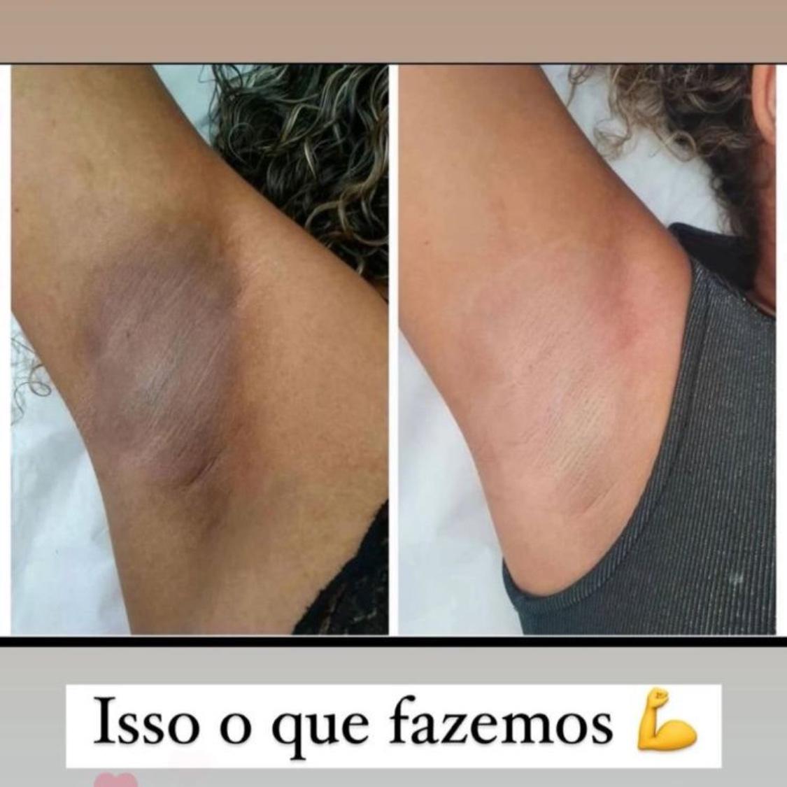 Clareamento  de Pele