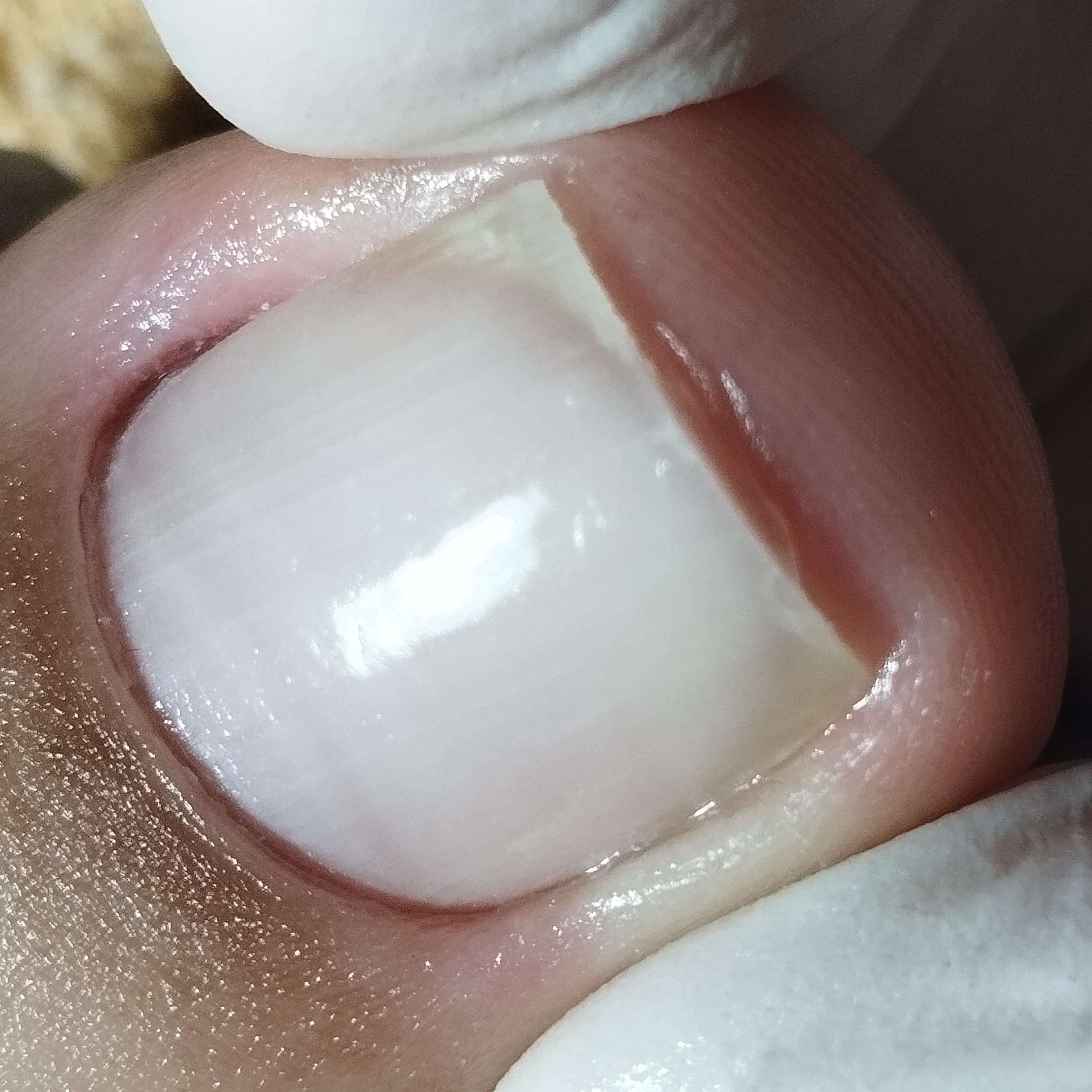 TRATAMENTO DE CORREÇÃO DE UNHAS