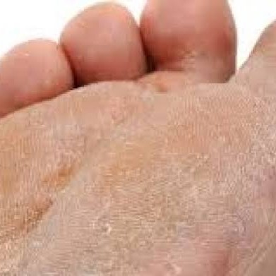 TRATAMENTO DE VERRUGA PLANTAR