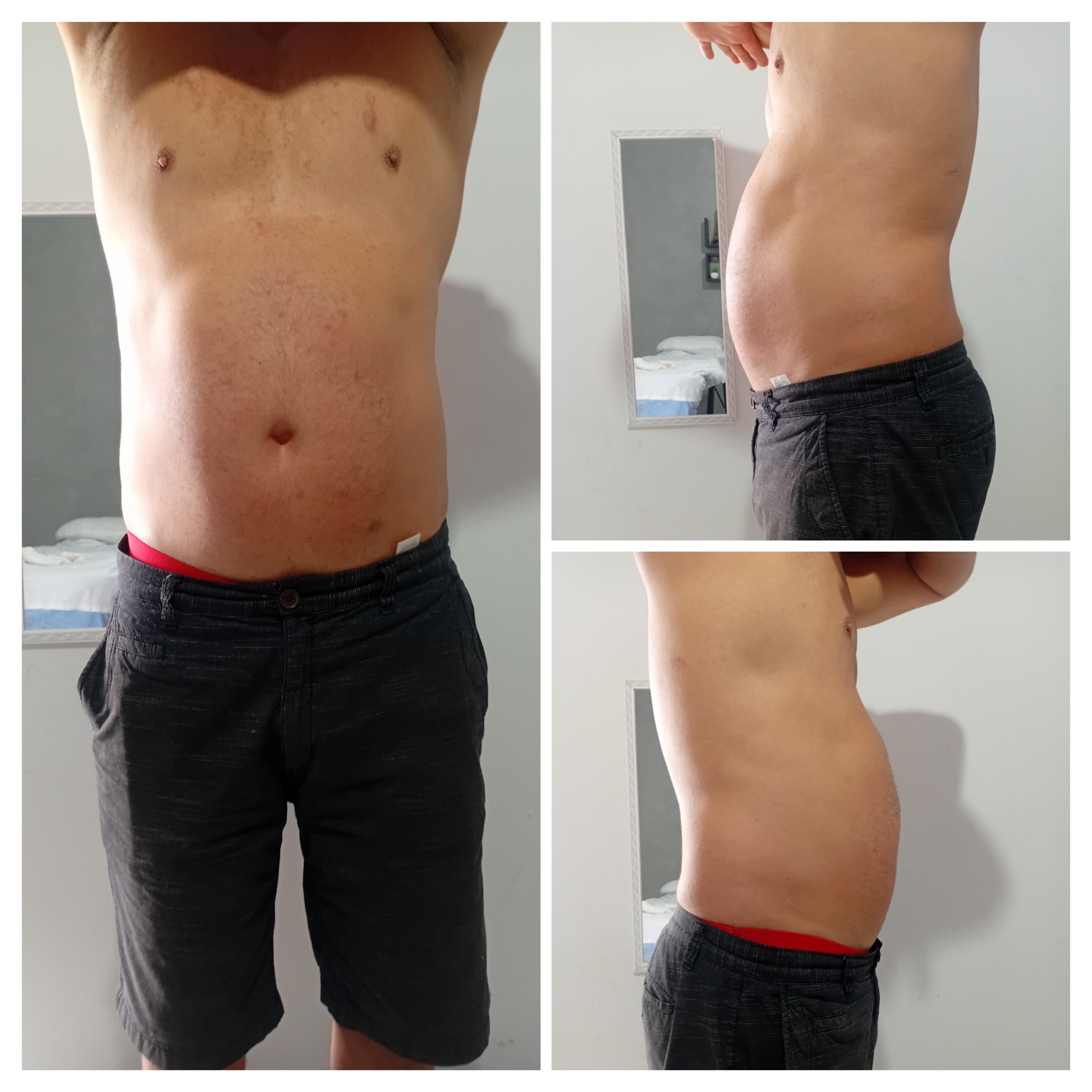 lipo genoide resistente (celulite)