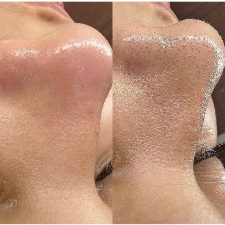 limpeza de pele