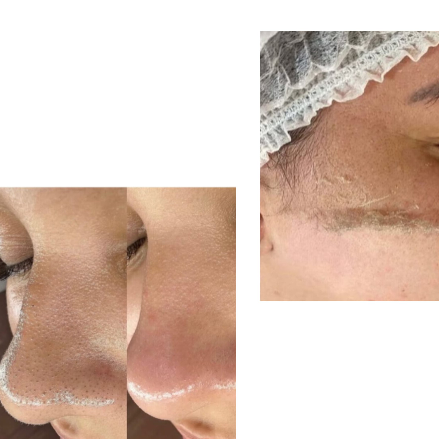 limpeza de pele+dermaplaning