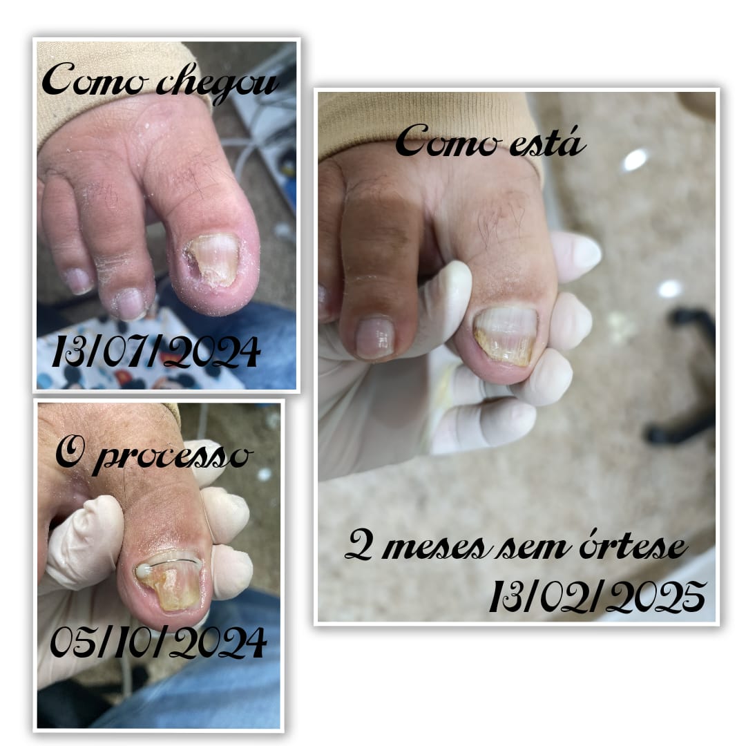 Órteses