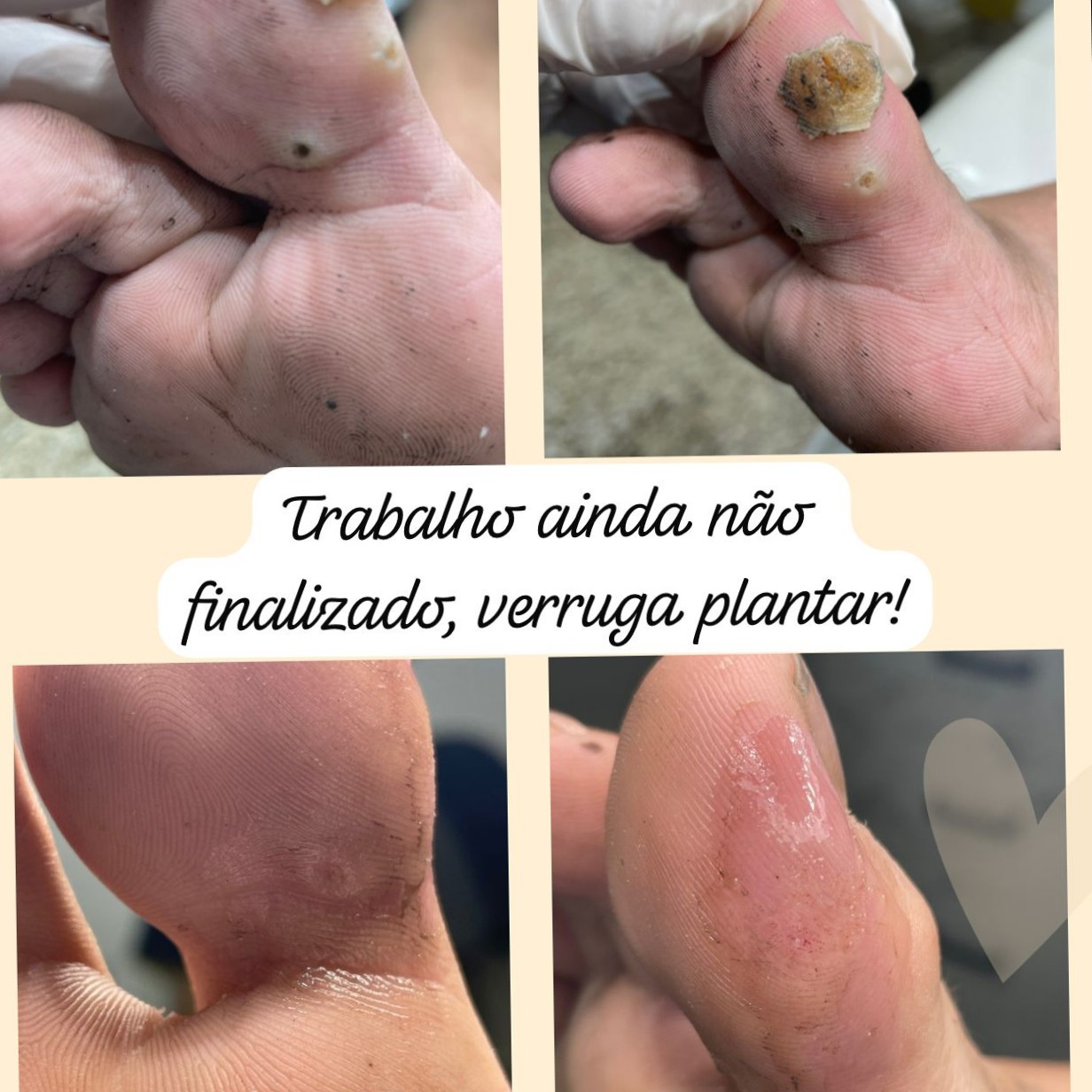 Tratamento de verruga