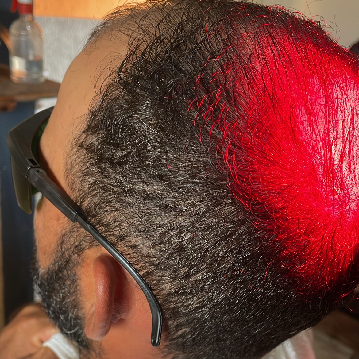 Terapia capilar