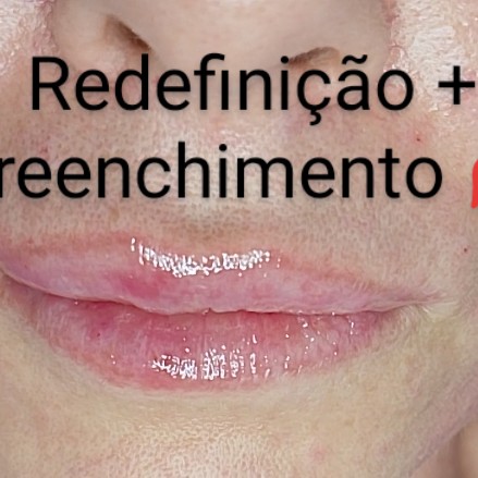 PREENCHIMENTO LABIAL