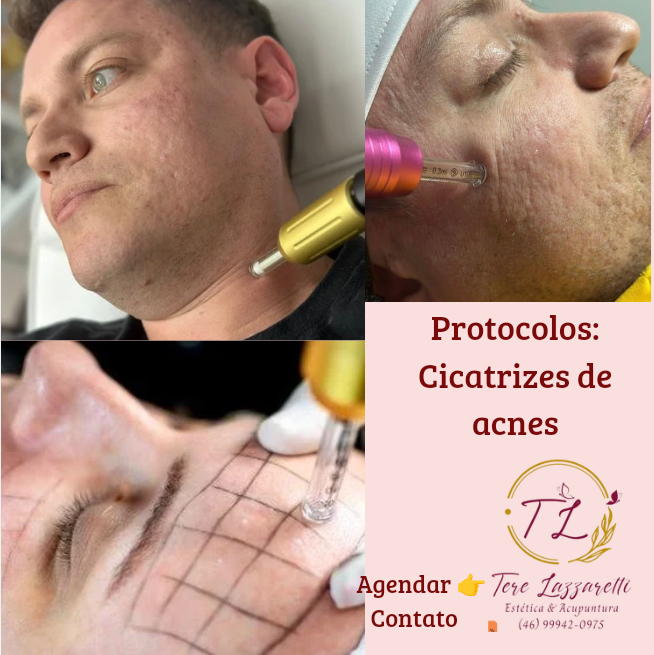 TRATAMENTO FACIAL CICATRIZ DE ACNE