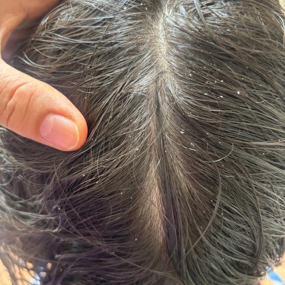 TRATAMENTO CAPILAR OLEOSIDADE E CASPA