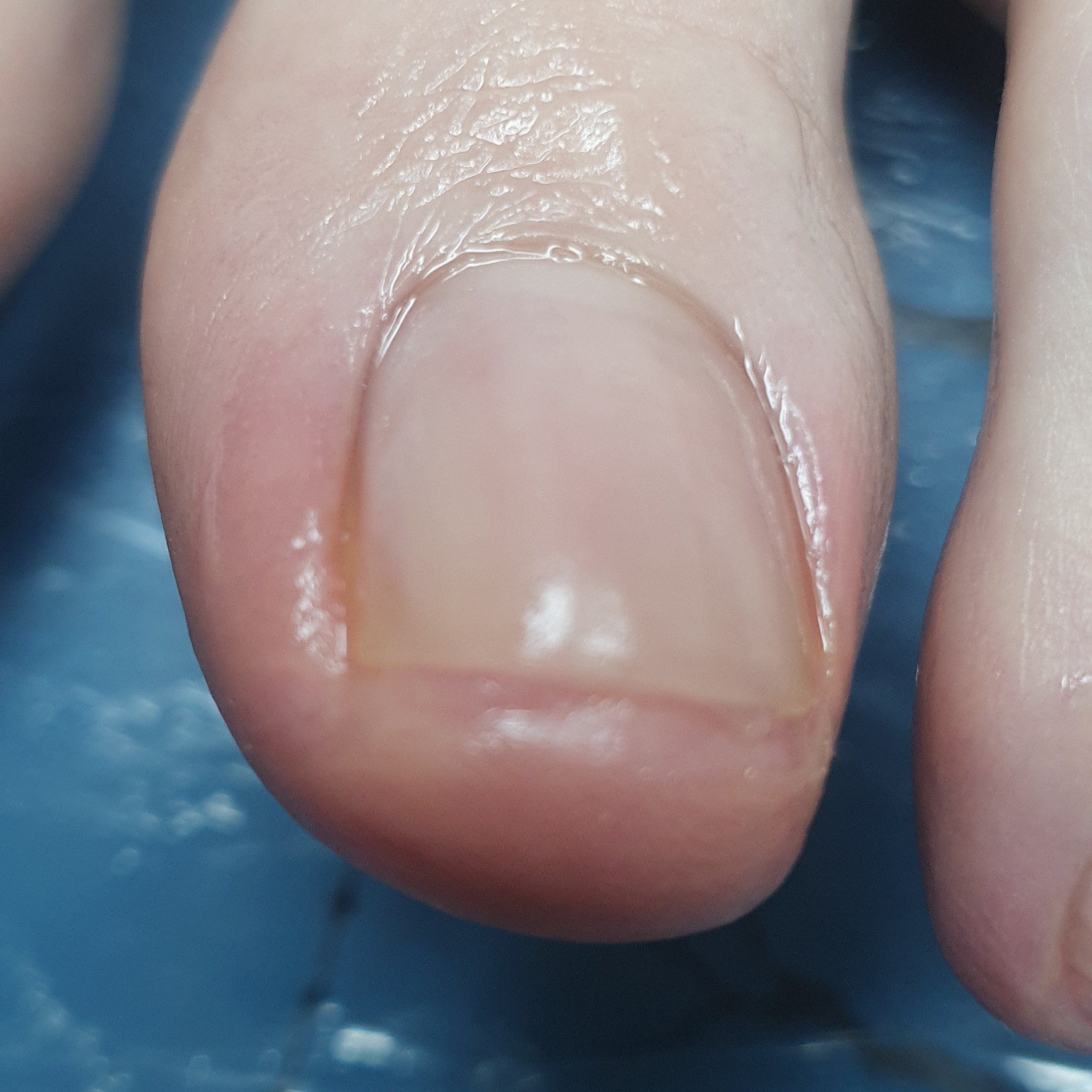 Onicotomia (Corta das unhas)