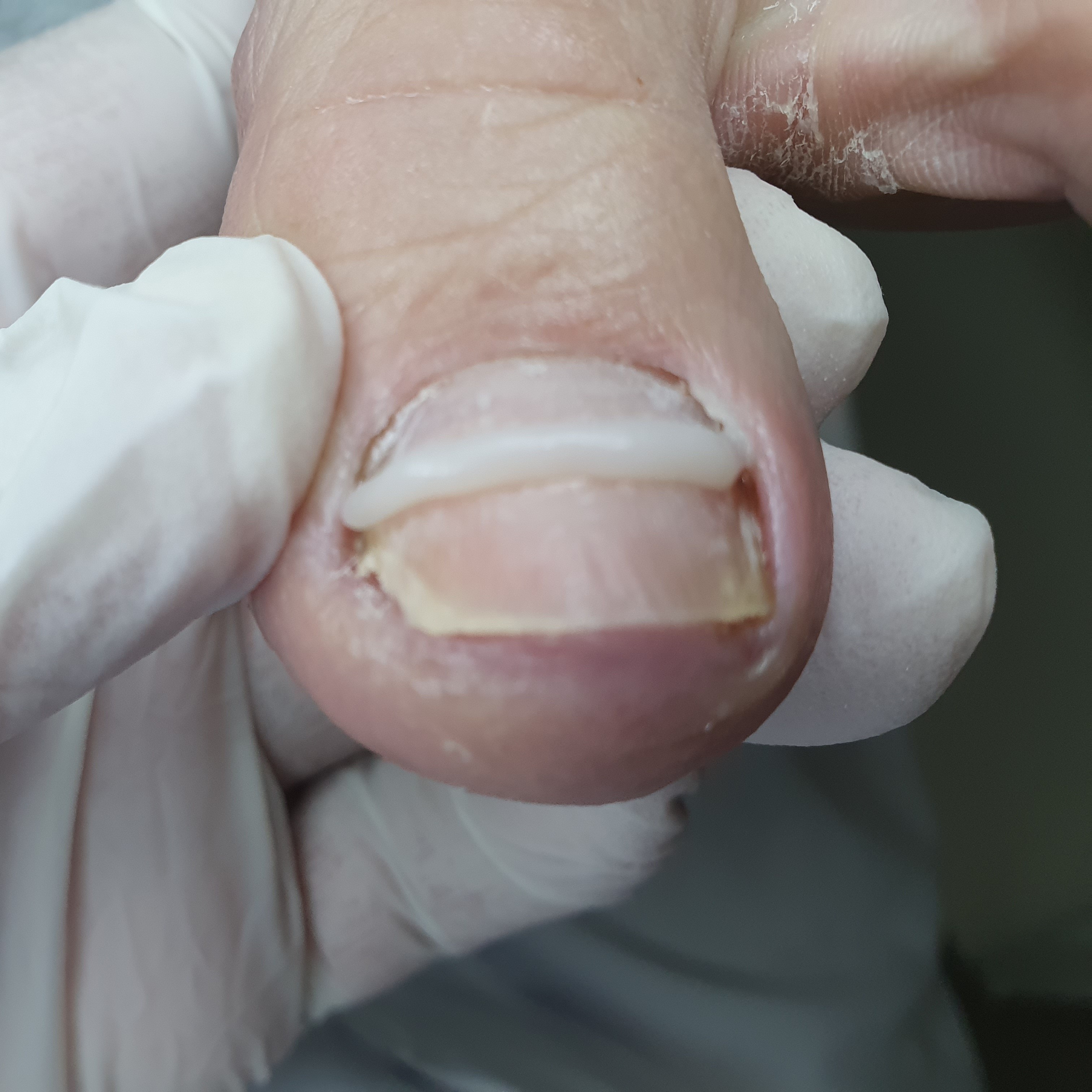 Órtese Corretiva(Unhas curvadas)