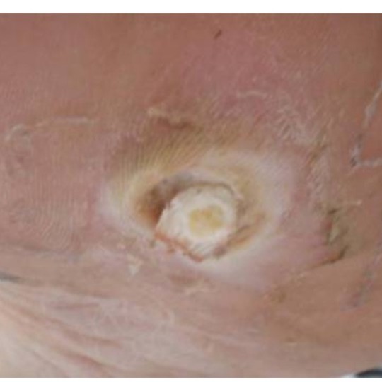 Verruga Plantar ( olho de peixe)