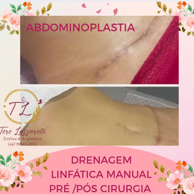 DRENAGEM LINFÁTICA LOCALIZADA PRÉ PÓS CIRURGIA