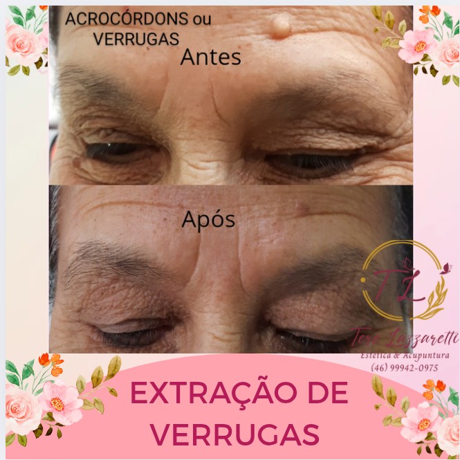 EXTRAÇÃO DE VERRUGAS (ACROCÓRDONS)