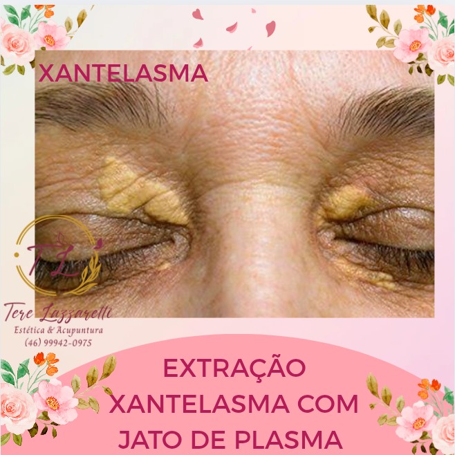 EXTRAÇÃO DE XANTELASMA (JATO DE PLASMA)
